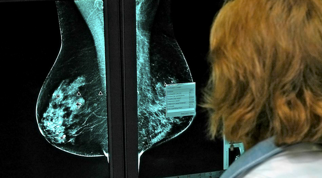 Por un error de logística del Municipio de Tandil se vencieron las mamografías donadas por el cluster quesero en 2020